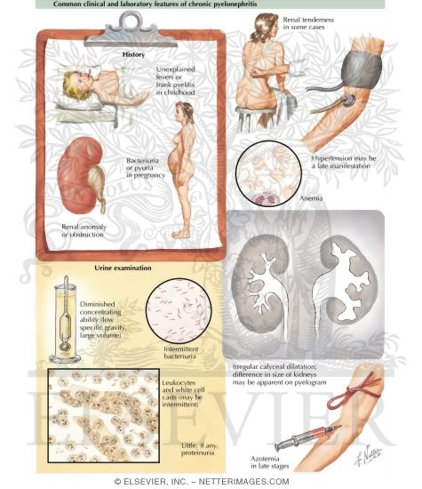 Watermarked preview of labeled image: Common Clinical and Laboratory Features of Chronic Pyelonephritis