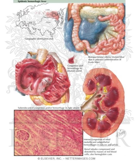 Watermarked preview of labeled image: Epidemic Hemorrhagic Fever