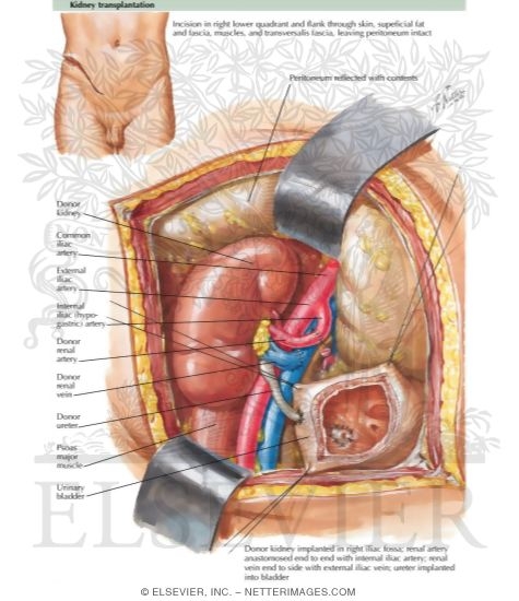Kidney Transplantation