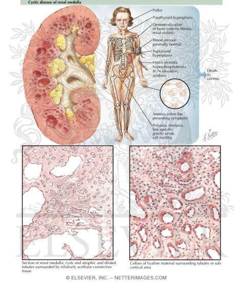 Watermarked preview of labeled image: Cystic Disease of Renal Medulla