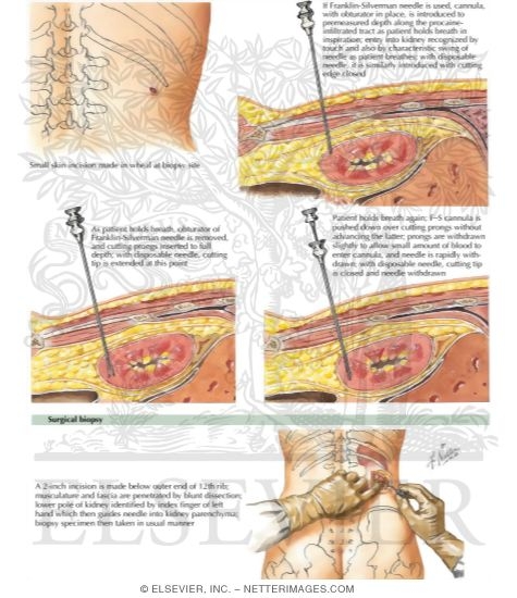 How is a kidney biopsy performed?