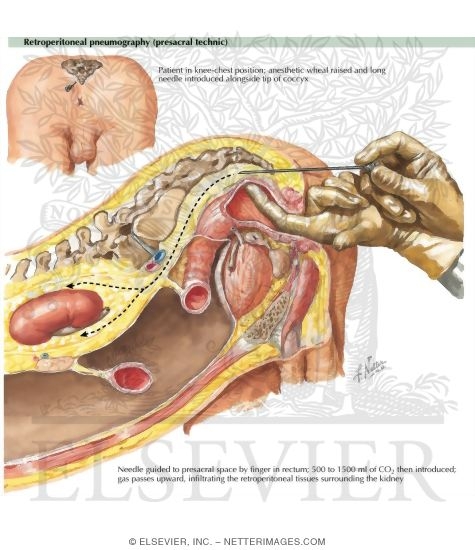 Watermarked preview of labeled image: Retroperitoneal Pneumography (Presacral Technic)