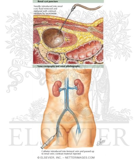 Watermarked preview of labeled image: Renal Cyst Puncture and Venous Studies