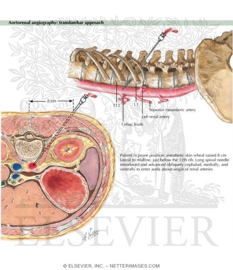 Watermarked preview of labeled image: Aortorenal Angiography: Translumbar Approach