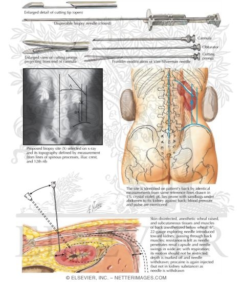 Renal Biopsy
