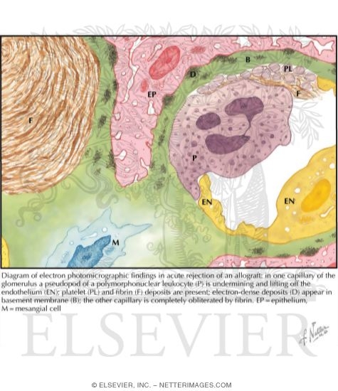 Watermarked preview of labeled image: Kidney Transplantation