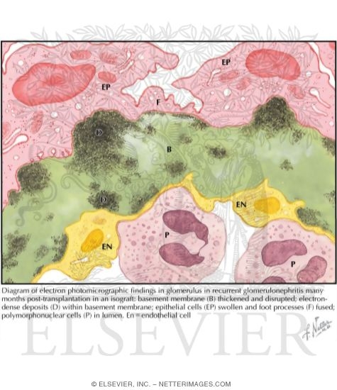 Watermarked preview of labeled image: Kidney Transplantation