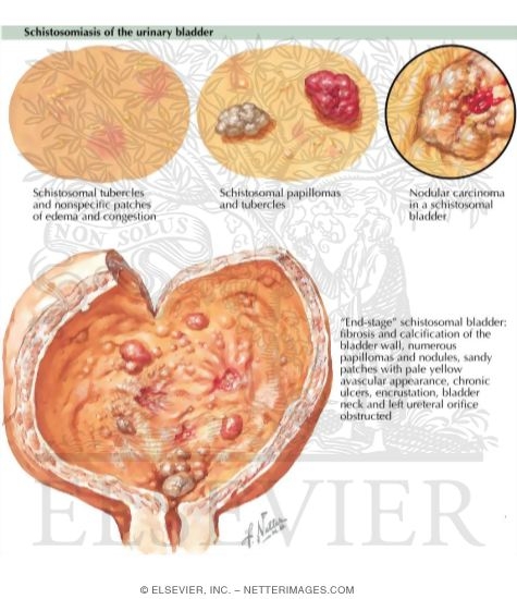 Urinary Schistosomiasis