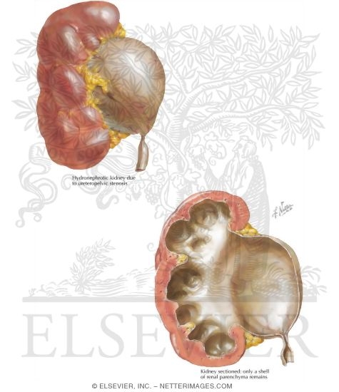 Obstructive Uropathy