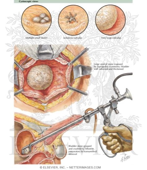 Watermarked preview of labeled image: Urinary Tract Calculi