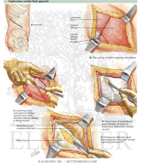 Nephrectomy (Routine Flank Approach)