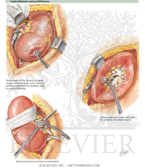 Nephrolithotomy and Pyelolithotomy
