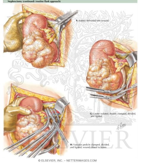 Nephrectomy (Routine Flank Approach)