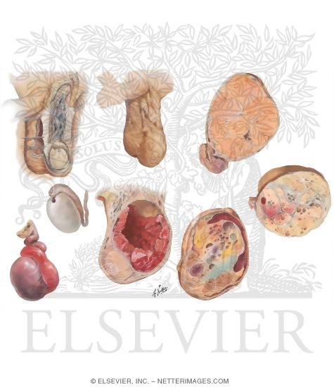 Varicocele, Hematocele, Torsion