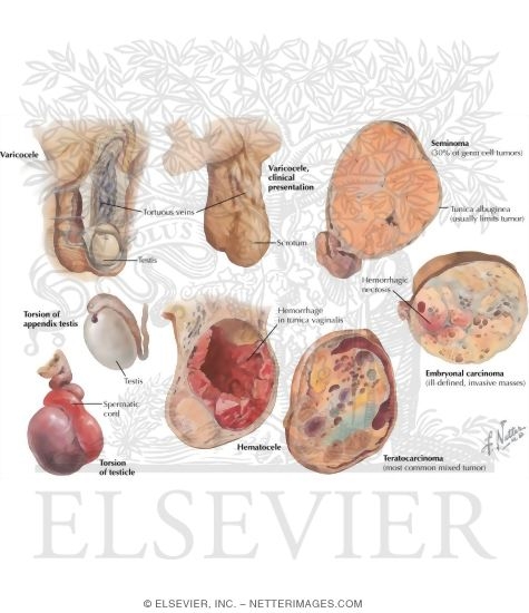 Varicocele, Hematocele, Torsion