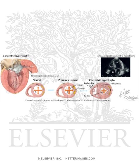 Watermarked preview of labeled image: Left Ventricular Hypertrophy