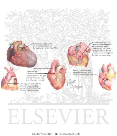 Watermarked preview of labeled image: Congenital Coronary Artery Anomalies