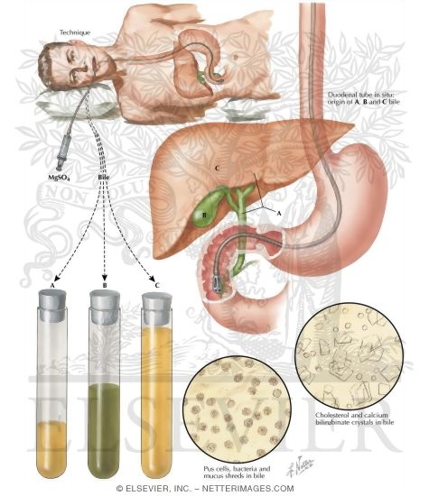 Watermarked preview of labeled image: Duodenal Drainage of Meltzer and Lyon