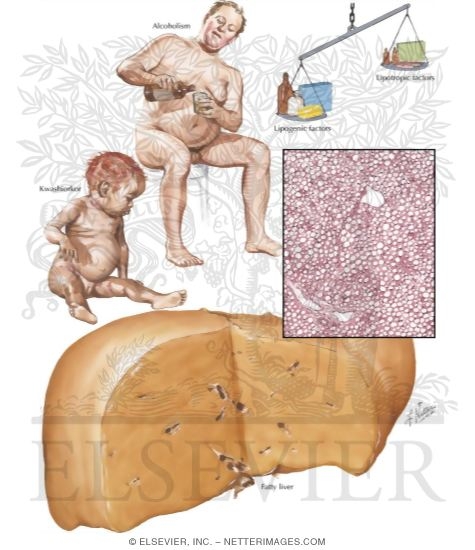 Watermarked preview of labeled image: Nutritional Liver Diseases