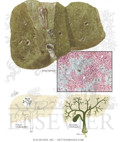 Watermarked preview of labeled image: Biliary Cirrhosis