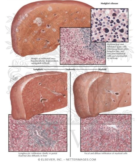 Hodgkin's Disease, Leukemia