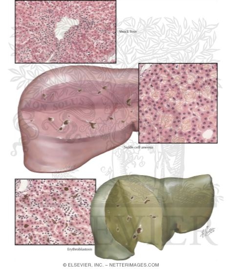 Watermarked preview of labeled image: Hypoxic Conditions-Shock, Sickle Cell Anemia, Erythroblastosis