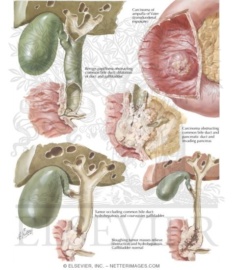 Watermarked preview of labeled image: Ampullary Tumors