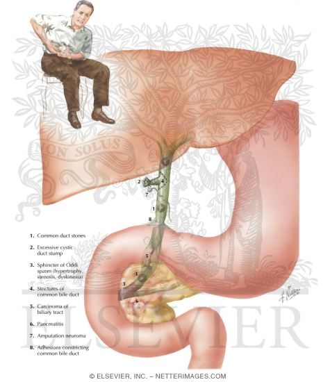 Watermarked preview of labeled image: Postcholecystectomy Syndrome