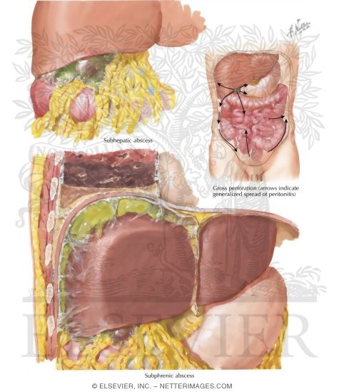 Watermarked preview of labeled image: Perforation, Subphrenic Abscess