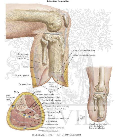 Watermarked preview of labeled image: Amputation of Lower Extremity