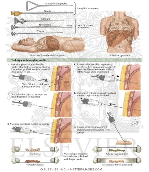 Liver Biopsy