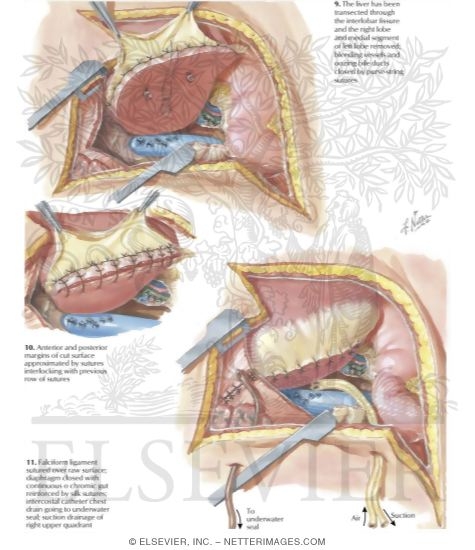 Watermarked preview of labeled image: Extended Right Lobectomy of the Liver (4 of 4)