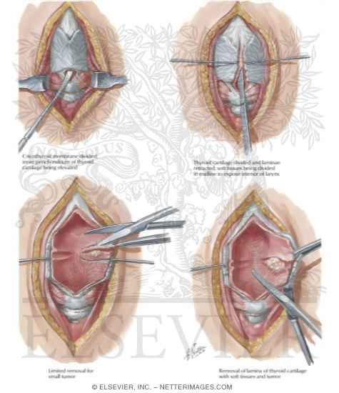 Watermarked preview of labeled image: Laryngofissure and Cordectomy