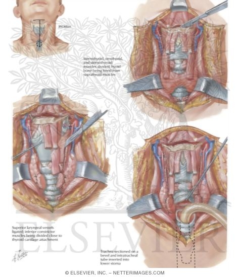 Watermarked preview of labeled image: Total Laryngectomy