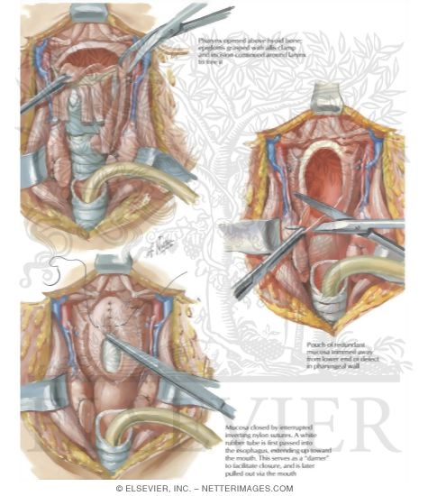 Total Laryngectomy