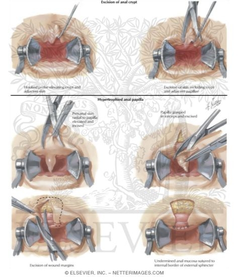 Anal Crypt: Hypertrophied Papilla