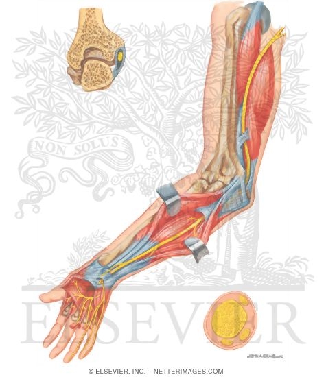 Illustration of Compression of Ulnar Nerve from the Netter Collection