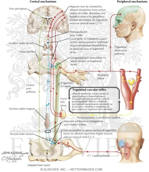 Watermarked preview of labeled image: Mechanisms in Migraine