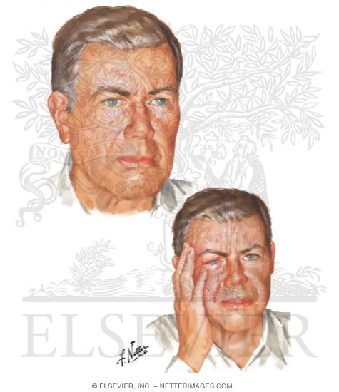 Watermarked preview of unlabeled image: Cluster Headache