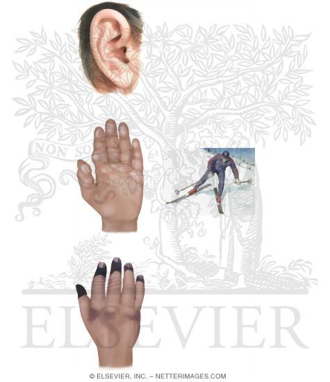 Watermarked preview of unlabeled image: Common Cold-Related Injuries