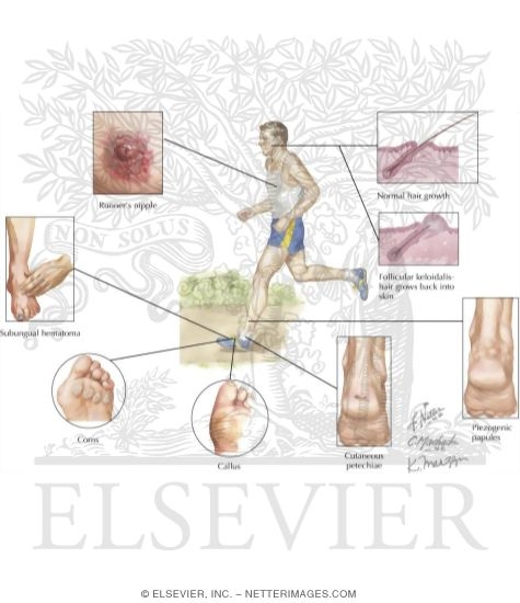 Watermarked preview of labeled image: Common Problems Caused By Friction and Pressure