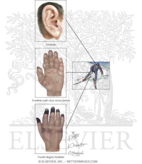 Watermarked preview of labeled image: Common Cold-Related Injuries