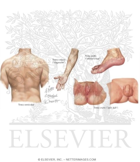 Watermarked preview of labeled image: Common Fungal Infections
