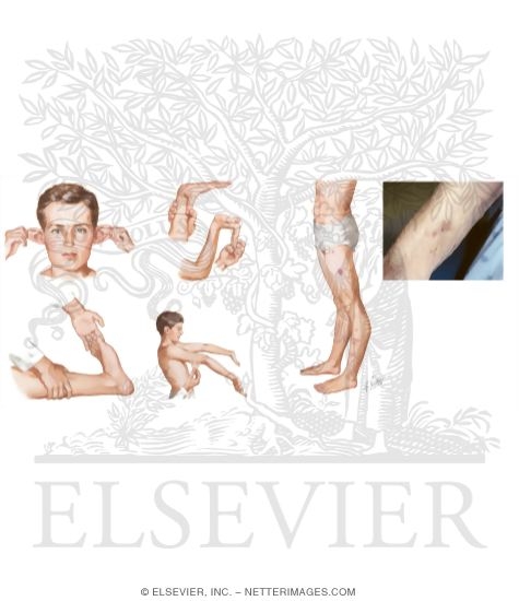 analysis and description of ehlers danlos syndrome Ehlers-danlos syndrome (eds) comprises a group of inherited heterogeneous disorders that share a common decrease in the tensile strength and integrity of the skin, joints, and other connective tissues. analysis and description of ehlers danlos syndrome Ehlers-danlos syndrome (eds) comprises a group of inherited heterogeneous disorders that share a common decrease in the tensile strength and integrity of the skin, joints, and other connective tissues.