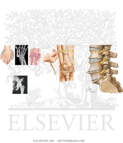 Watermarked preview of unlabeled image: Characteristics of Osteoarthritis Or Degenerative Arthropathy