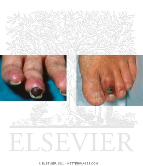 Characteristics of Buerger's Syndrome (Thromboangitis Obliterans)