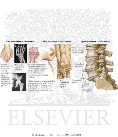 Watermarked preview of labeled image: Characteristics of Osteoarthritis Or Degenerative Arthropathy