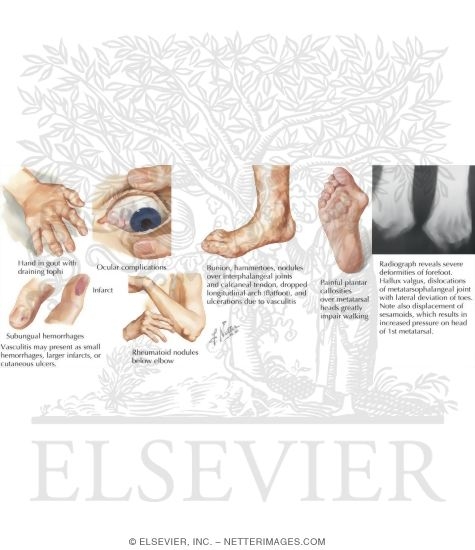 Watermarked preview of labeled image: Characteristics of Rheumatoid Arthritis
