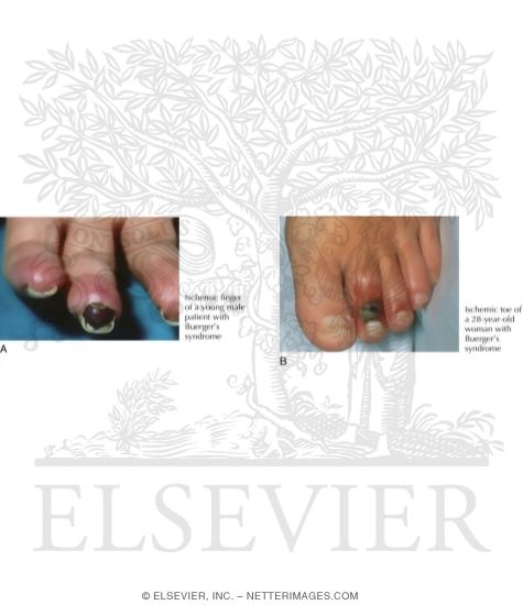 Watermarked preview of labeled image: Characteristics of Buerger's Syndrome (Thromboangitis Obliterans)