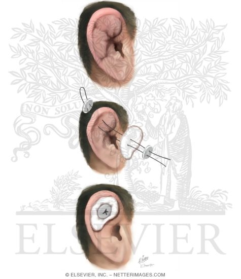 Watermarked preview of unlabeled image: Cauliflower Ear